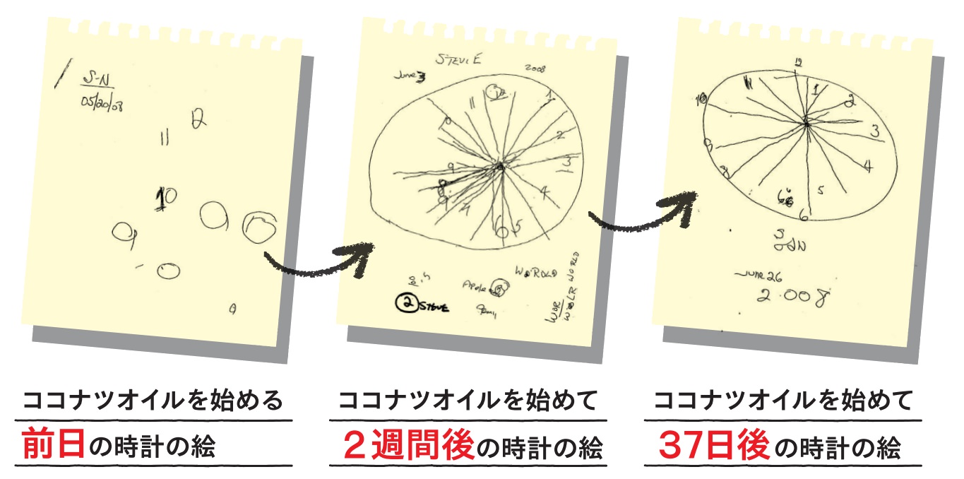 テスト 絵 アルツハイマー